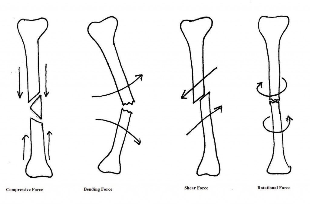 Figure 1 Forces on a fracture 
