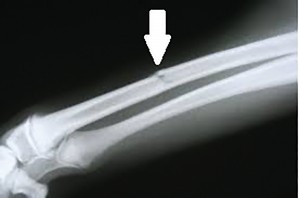 Minimally displaced radial fracture