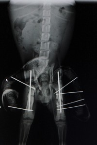 Both fractures required surgical stabilization using an external skeletal fixator.
